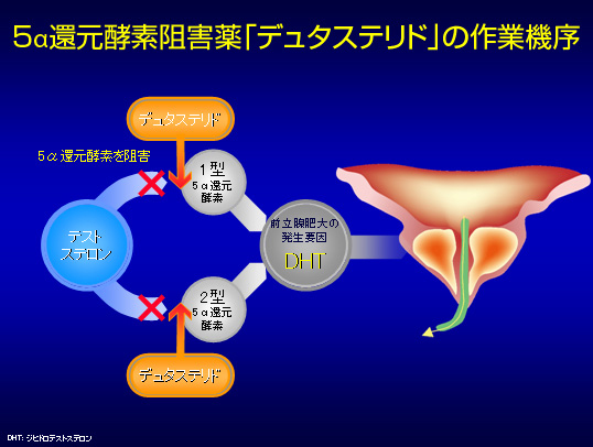 前立腺肥大症治療に朗報