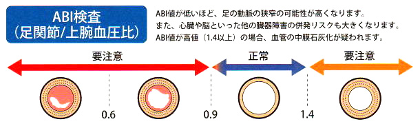 “動脈硬化”とは？